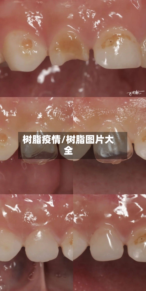 树脂疫情/树脂图片大全-第3张图片